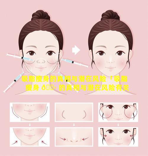 吸脂瘦身的真相与潜在风险「吸脂瘦身 🌷 的真相与潜在风险有关吗」